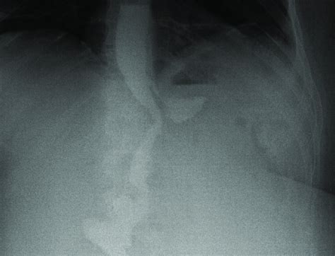 Gastric fistula near angle of His. | Download Scientific Diagram