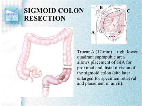 Laparoscopic Trocar Placement