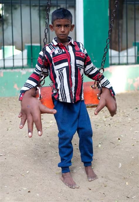 'Boy with the World's Biggest Hands' measuring 33cm has surgery to ...