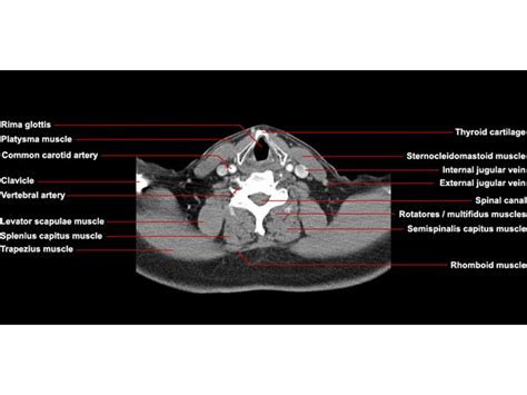 Slide23 in 2021 | Sternocleidomastoid muscle, Anatomy, Vertebral artery