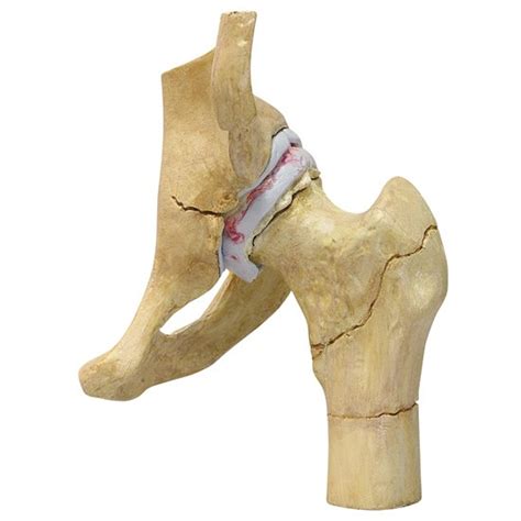 Degenerative Bone Diseases of the Hip Model (4 stages) 1320 | Hip Diagnosis