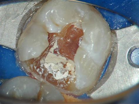 Endodontics: Pulp Capping : Enhanced Dental CPD Online