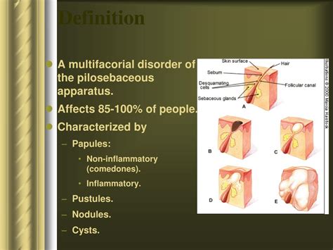 PPT - Disorders of Sebaceous Glands PowerPoint Presentation, free ...