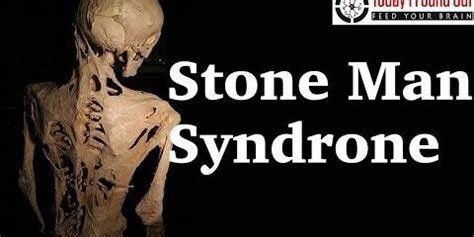 Stone-man Syndrome