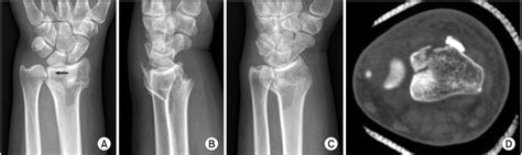 Radiographs of 57-year-old woman with left distal radius fracture.... | Download Scientific Diagram