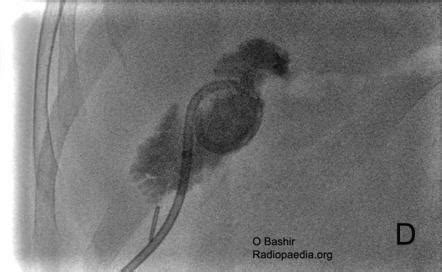 Percutaneous cholecystostomy | Radiology Reference Article | Radiopaedia.org