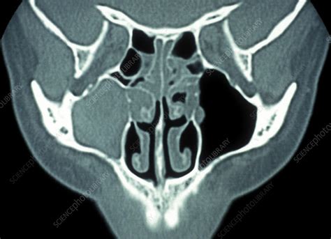 Infected maxillary sinus, CT scan - Stock Image - M260/0404 - Science ...