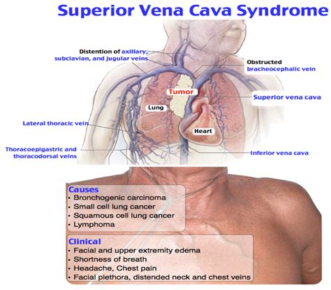 Inferior Vena Cava Syndrome