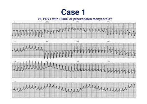 Differentiation between AVNRT and AVRT_advanced lecture