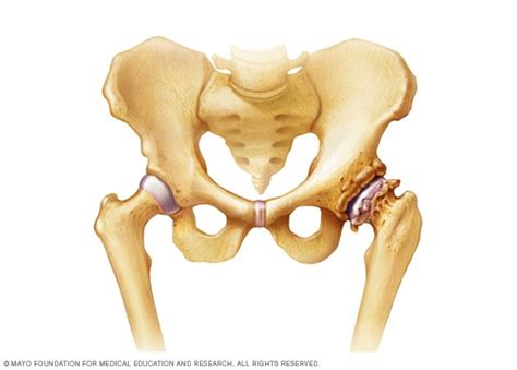 Bone spurs Disease Reference Guide - Drugs.com