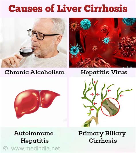 Liver Cirrhosis - Causes, Symptoms, Diagnosis, Treatment & Prevention