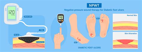 Negative Pressure-Wound Therapy | Center for Wound Healing and ...