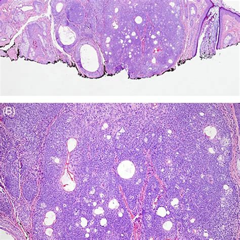 Multiple, rounded cysts characteristic of steatocystoma multiplex... | Download Scientific Diagram