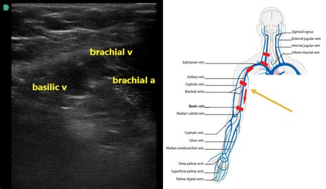 Picc Line Brachial Vein