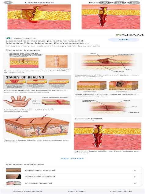 Deep Abrasion Diagram Wound - Google Search