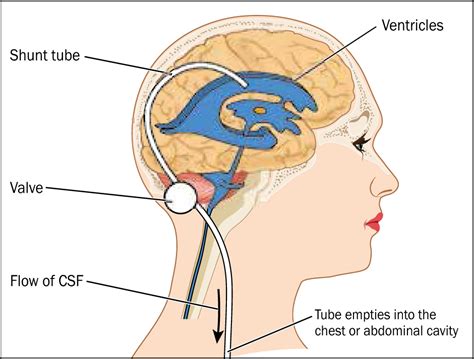 Hydrocephalus Shunt