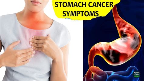 Stomach Cancer Early Sign and Symptoms | Gastric Cancer - YouTube