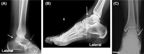 Avulsion fractures in the foot: telltale radiographic signs to avoid ...