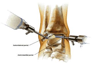 Ankle Arthroscopy Procedure | Spine & Orthopedic Center