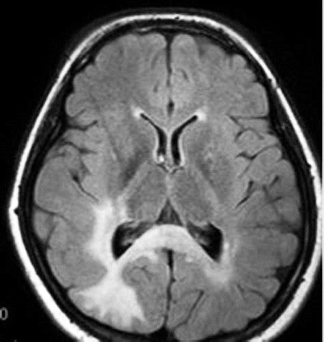 White Matter Diseases with Radiologic-Pathologic Correlation | RadioGraphics