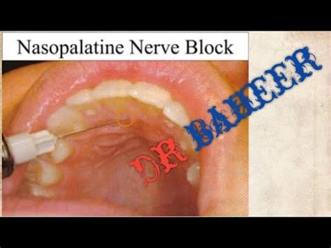 nasopalatine nerve block - YouTube