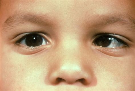 Strabismus: Infantile Esotropia - American Academy of Ophthalmology