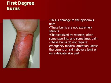 Stages of burn healing for 2nd degree burn - drivergulf