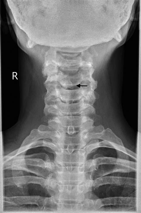 Cervical spine radiology - Anaesthesia & Intensive Care Medicine