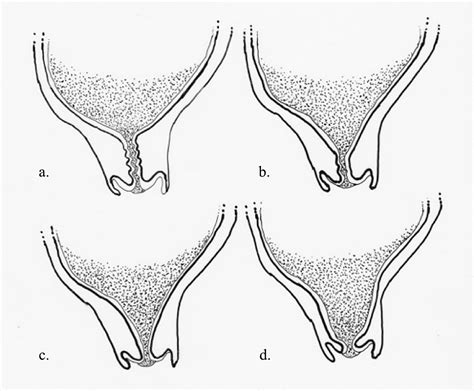 Cureus | Cervical Funneling: Potential Pitfall of Point-of-Care Pelvic Ultrasound