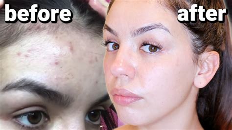 How i cleared my skin - benzoyl peroxide for acne - Audrey Victoria