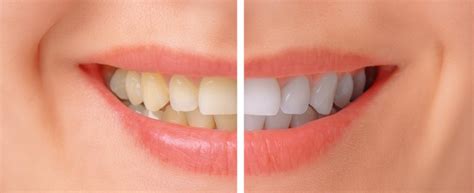 Teeth Whitening Options for Sensitive Teeth | Langley Dental Practice | Dentagama