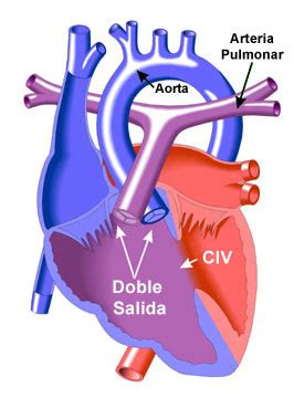 Doble Tracto de Salida del Ventrículo Derecho | Congenital Heart Disease - Cove Point Foundation ...