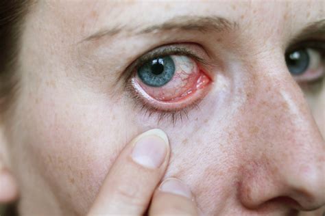 Preventing Red Eye and Infection Associated with Swimming Pools ...