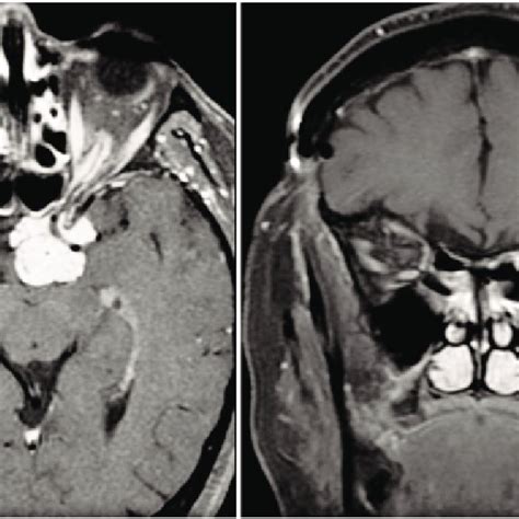 (PDF) Optic nerve sheath meningioma: Current diagnosis and treatment