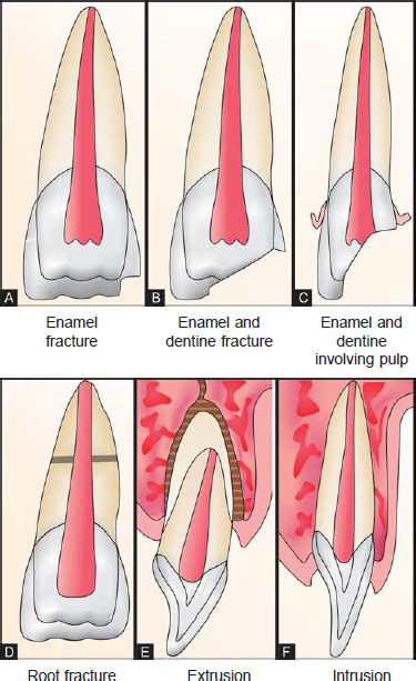 Ellis classification for tooth fracture | News | Dentagama