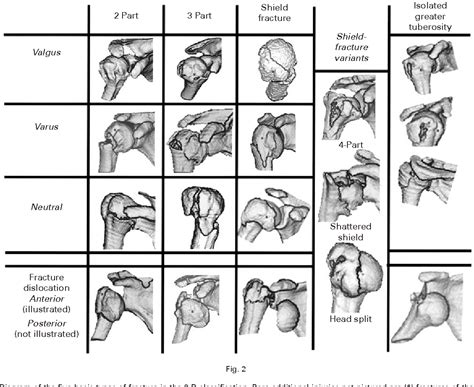 Figure 2 from A three-dimensional classification for fractures of the ...