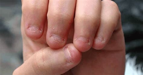 11 Shocking Facts That Might Help You To Stop Biting Your Nails