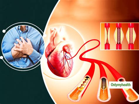 Stent And Bypass Surgery: Is It Beneficial For Heart Patients? Play ...