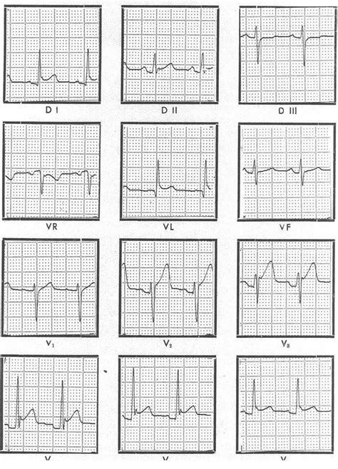 Pericardial Drain Nursing Management - Best Drain Photos Primagem.Org