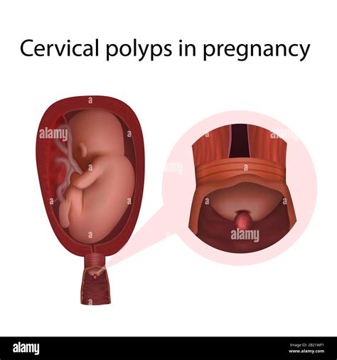 Cervical polyps hi-res stock photography and images - Alamy