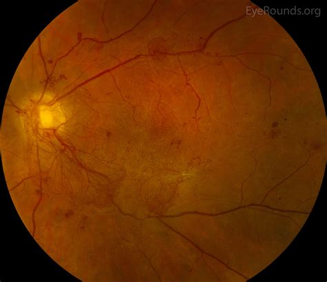 Retinal Hemorrhage Diagram