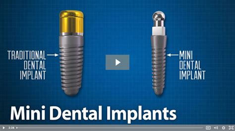 What is the difference between mini dental implants and regular implants - Dental News Network