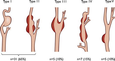 National Experience with Extracranial Carotid Artery Aneurysms ...