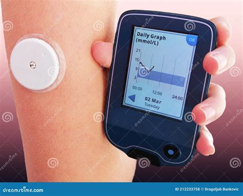 Device for Continuous Glucose Monitoring of Blood Sugar Levels â€“ CGM Stock Photo - Image of ...