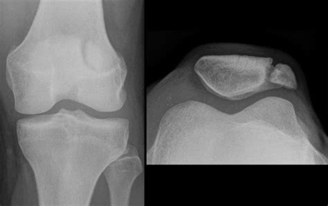 Bipartite Patella X-Ray - radRounds Radiology Network