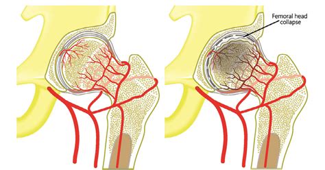 Avascular Necrosis Symptoms Causes Diagnosis Treatment Prevention ...