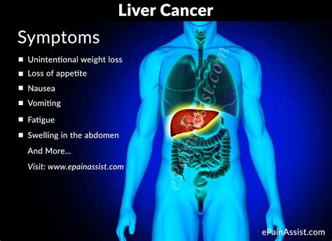Liver Pain Location Causes And Treatment