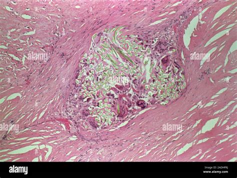 Granuloma reaction to suture. Light micrograph of a section through a ...