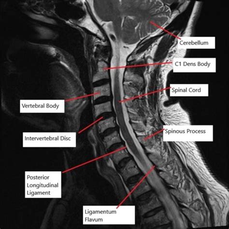 Cervical Corpectomy Surgery - Complete Orthopedics & Podiatry ...