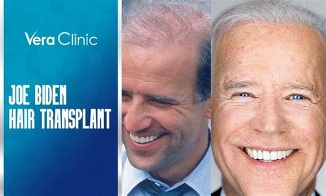 Joe Biden Hair Transplant - Vera Clinic